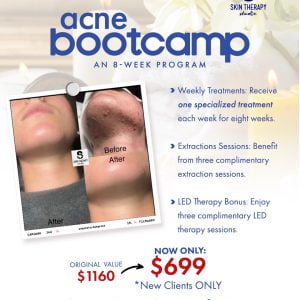 Acne Bootcamp
